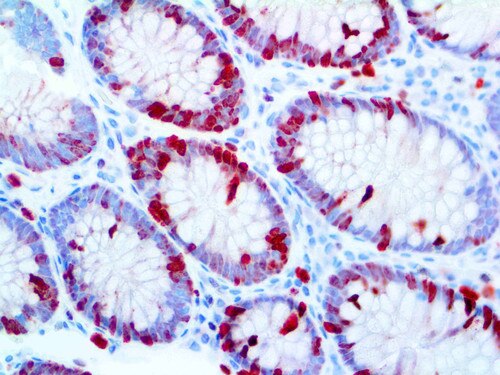 Ki-67 Antibody Immunohistochemistry on an FFPE Colon Tissue